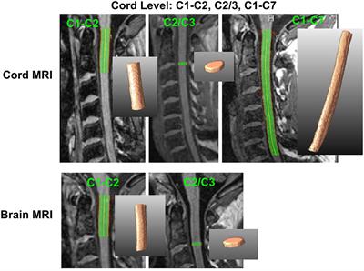 Quantification of Cervical Cord Cross-Sectional Area: Which Acquisition, Vertebra Level, and Analysis Software? A Multicenter Repeatability Study on a Traveling Healthy Volunteer